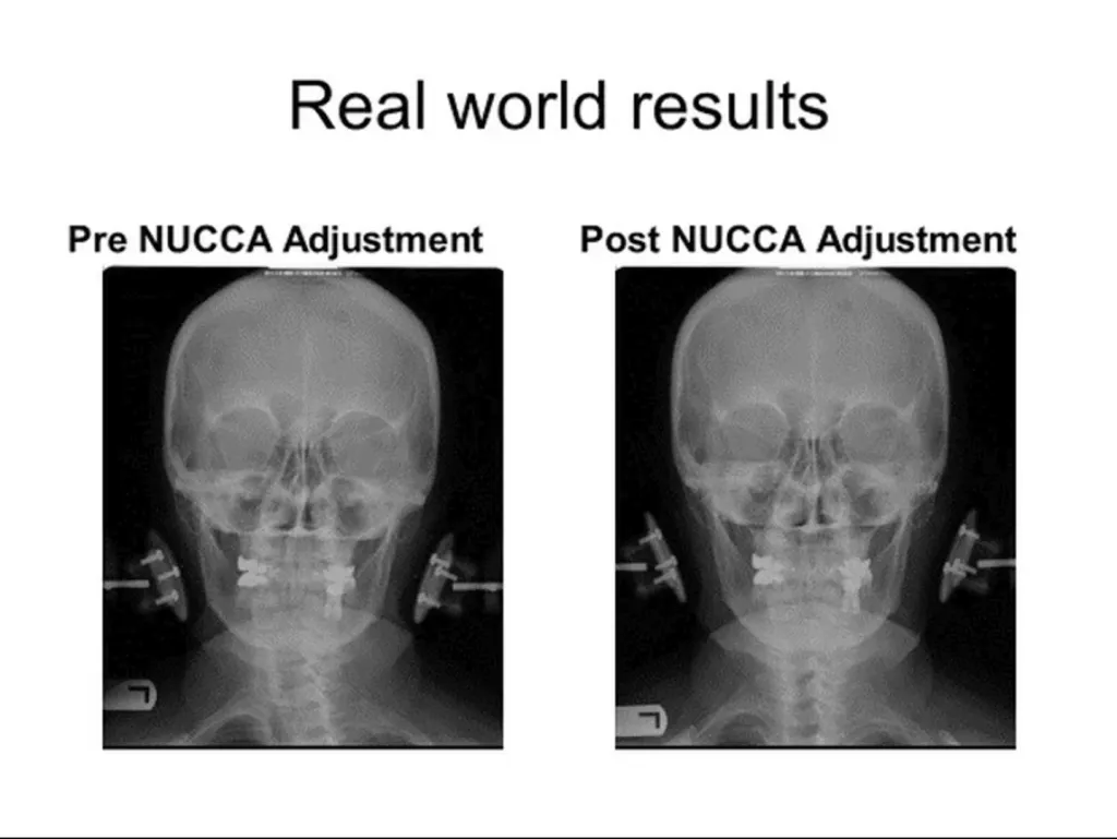 Pre- and post-NUCCA correction X-ray comparison